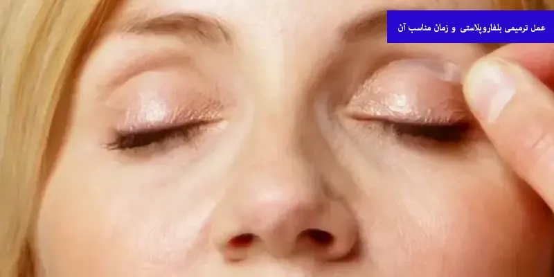 عمل ترمیمی بلفاروپلاستی و زمان مناسب آن